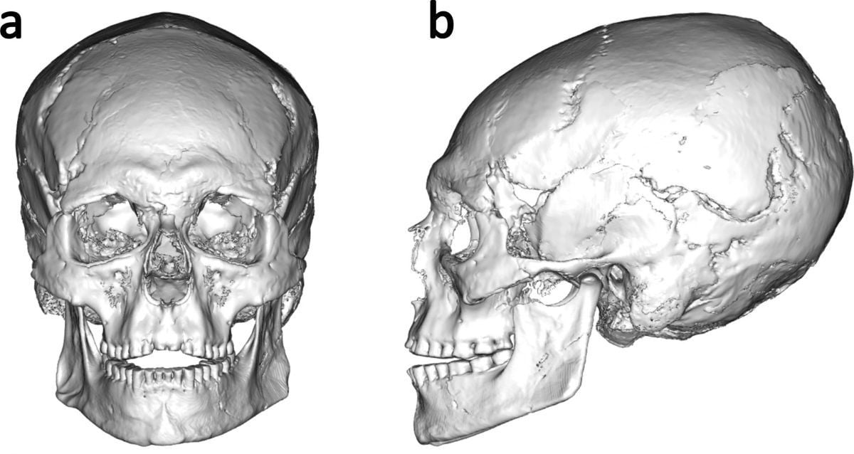 Novo estudo encontra um exemplo mais antigo de modificação craniana na Europa